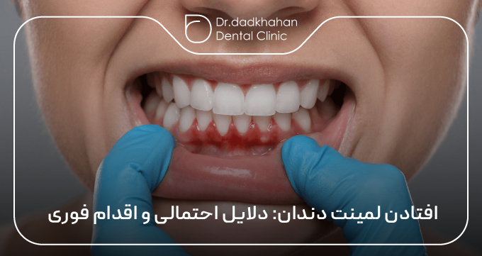 افتادن لمینت دندان: دلایل احتمالی و اقدام فوری