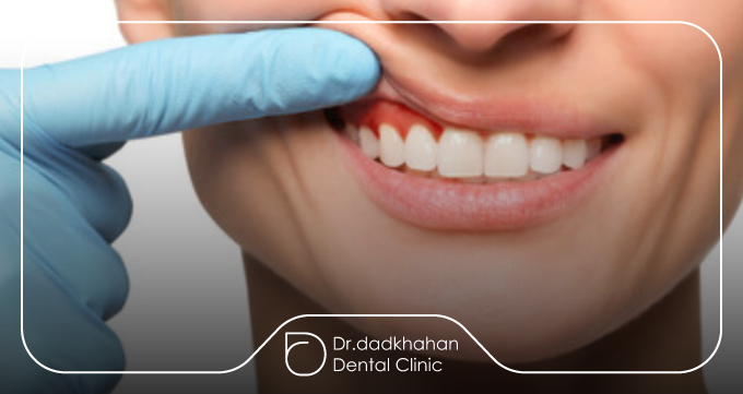 لمینت دندان چیست و چرا محبوب است؟