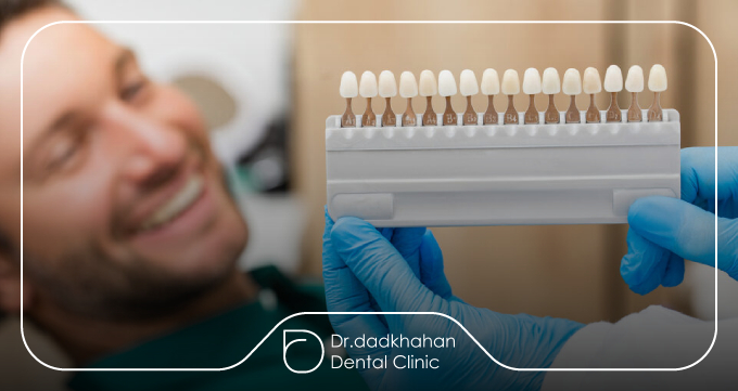 لمینت سرامیکی چیست؟