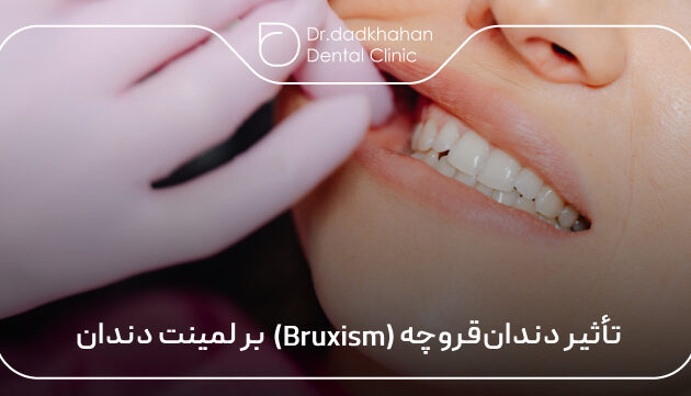 تأثیر دندان قروچه (Bruxism) بر لمینت دندان