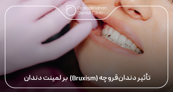 تأثیر دندان قروچه (Bruxism) بر لمینت دندان