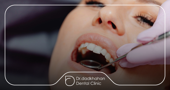  مزایای استفاده از لمینت برای ترمیم لب‌پریدگی