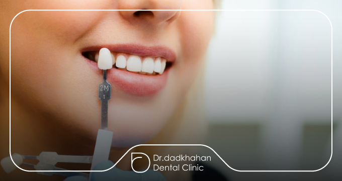 لمینت دندان چیست و چه کاربردی دارد؟