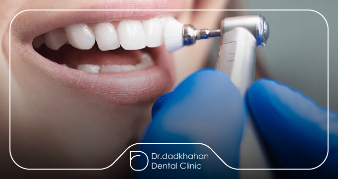 لمینت دندان چیست؟