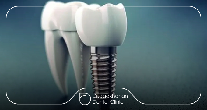 هر چند وقت یکبار ایمپلنت نیاز به جرمگیری دارد؟