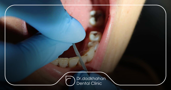 تعریف استریپ کردن دندان