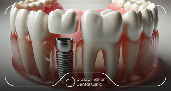 عوامل پزشکی و ژنتیکی مؤثر بر شکست ایمپلنت