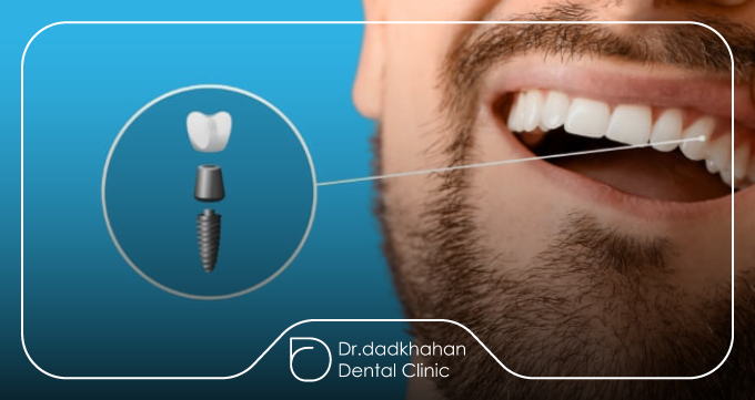 شناخت ایمپلنت دندان و فرایند جراحی
