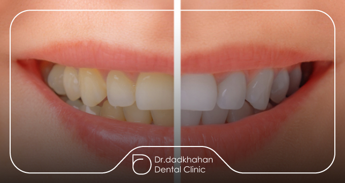 مقایسه روشهای سفیدکردن دندان