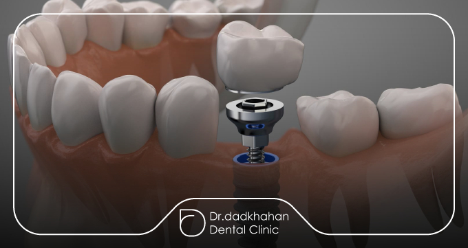 نشانههای ایمپلنت ناموفق