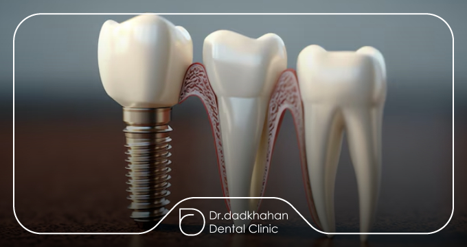 ایمپلنت دندان چیست و چرا نگهداری آن مهم است؟