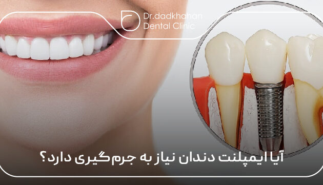آیا ایمپلنت دندان نیاز به جرم‌گیری دارد؟ 