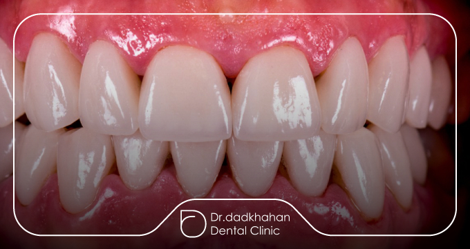 مراحل انجام استریپ کردن دندان