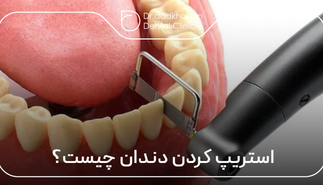 استریپ کردن دندان چیست؟
