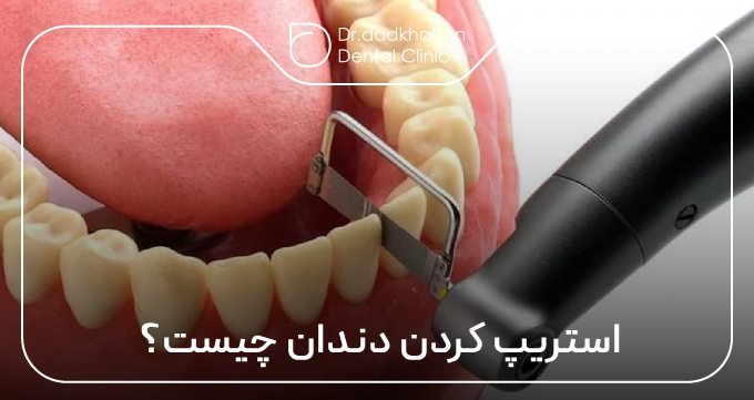 استریپ کردن دندان چیست؟