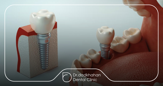 آشنایی با ایمپلنت دندان