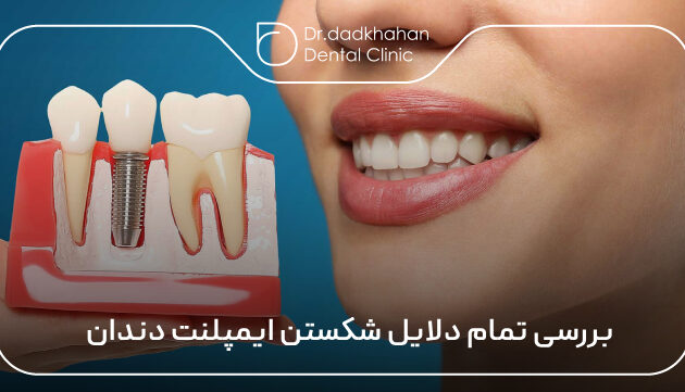 بررسی تمام دلایل شکستن ایمپلنت دندان