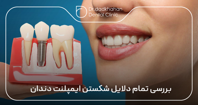 بررسی تمام دلایل شکستن ایمپلنت دندان