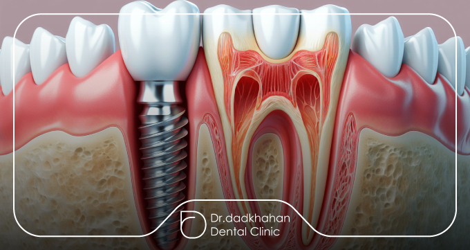 ایمپلنت دندان چیست و چرا لق شدن آن اهمیت دارد؟