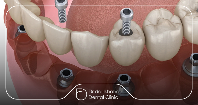 پیشگیری از لق شدن ایمپلنت