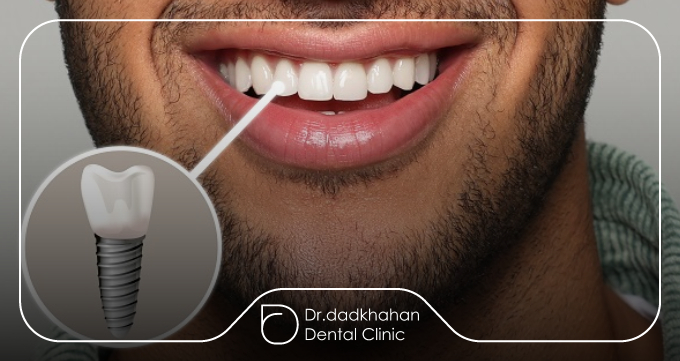 روزهای ابتدایی بعد از جراحی ایمپلنت