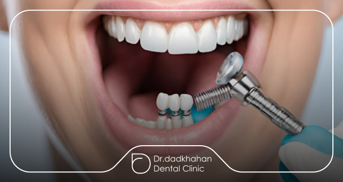 ایمپلنت دندان چیست و چگونه عمل می‌کند؟