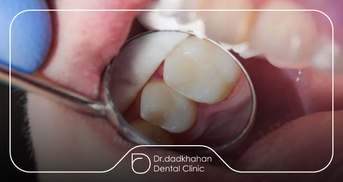 تعریف کامپوزیت و پرکردگی دندان
