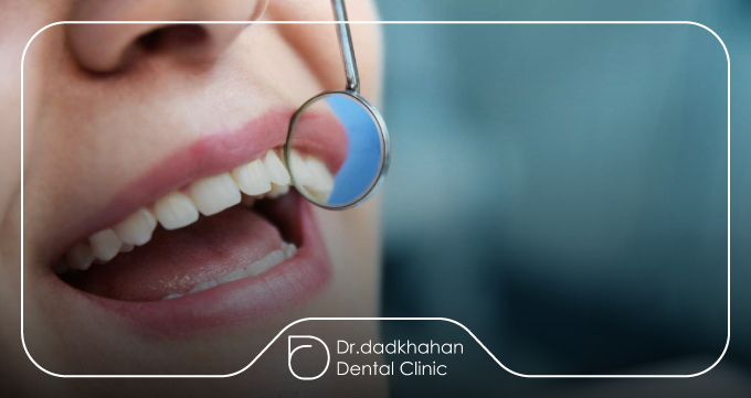 چه زمانی انجام کامپوزیت روی دندان پر شده ممنوع است؟