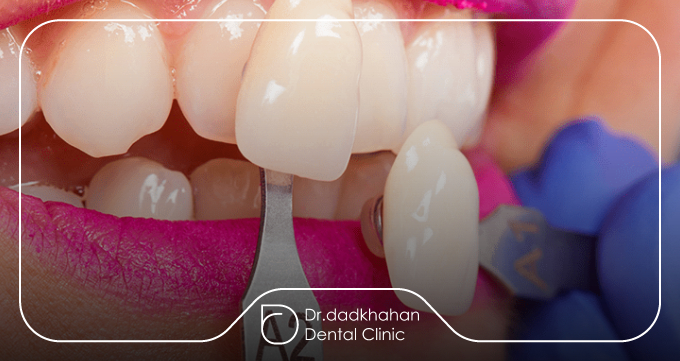 مراحل برداشتن کامپوزیت دندان