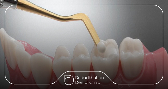 تفاوت ظاهری کامپوزیت و روکش