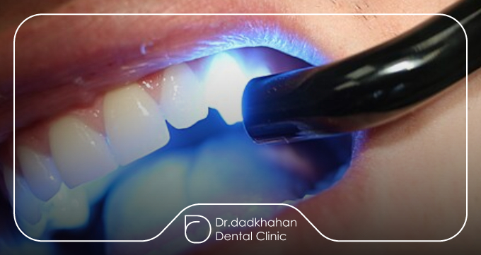 حساسیت به مواد کامپوزیت