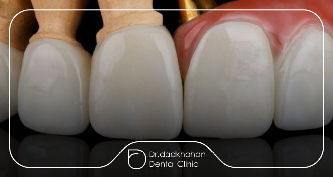 معایب و محدودیتها