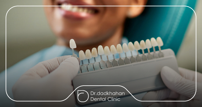 لمینت کریستالی در یک نگاه