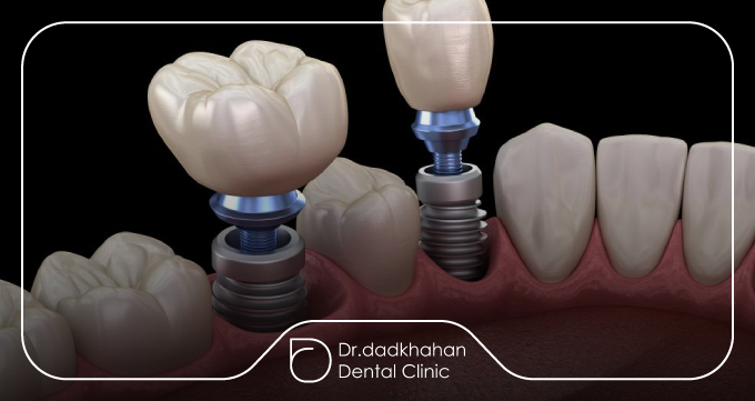اباتمنت ایمپلنت دقیقاً چه کاری انجام میدهد؟
