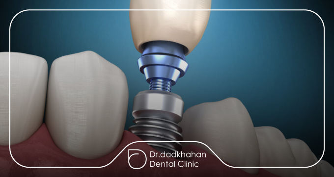 آشنایی با اباتمنت ایمپلنت از نگاه بالینی