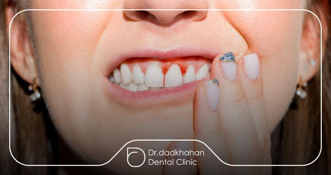 خونریزی لثه؛ اولین هشدار جدی که اغلب نادیده گرفته میشود