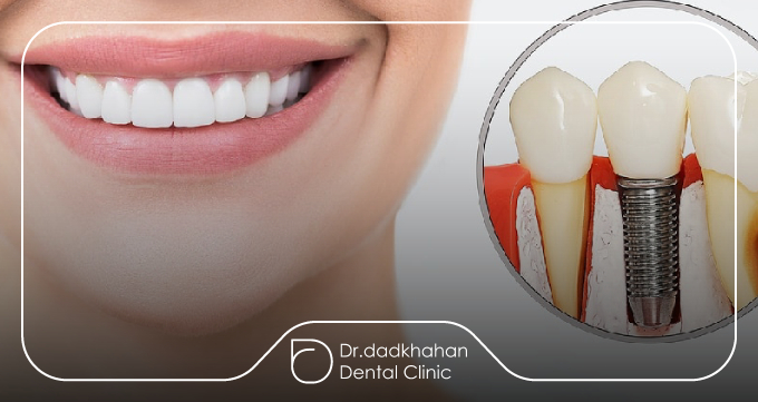 چرا مراحل ایمپلنت برای شما مهم است؟