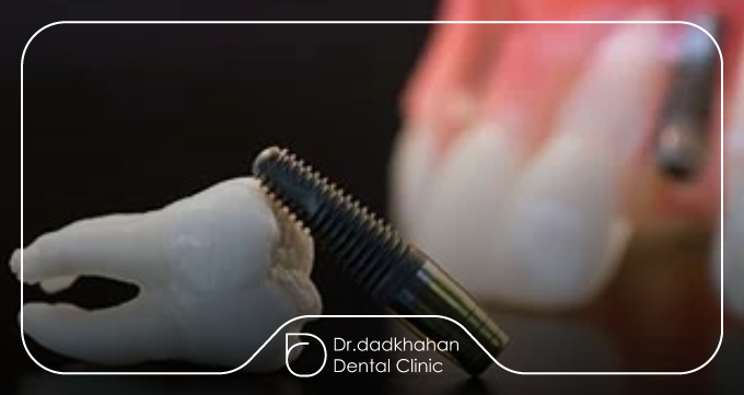 پیوند استخوانی و آمادهسازی محل ایمپلنت (مرحله ۲)