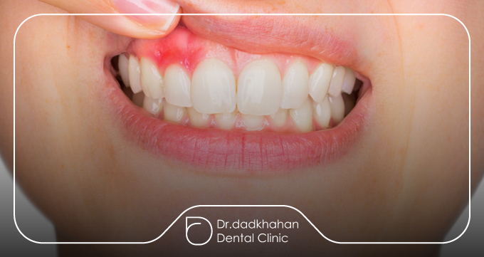 چرا عفونت ایمپلنت دندان خطرناک است؟