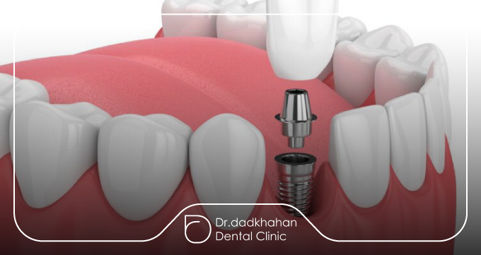 انواع فیکسچر ایمپلنت دندان